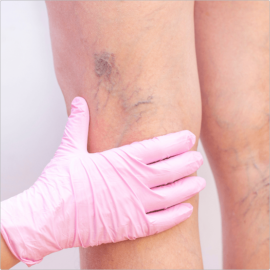 Vein leg Image