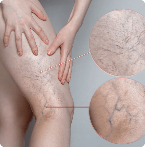 Chronic Venous Insufficiency (CVI)