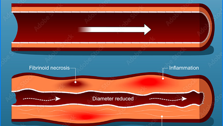 Questions Answered: A Q&A with a Varicose Specialist