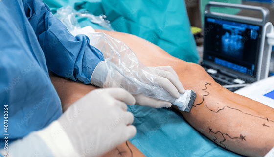 Vein Surgery Image