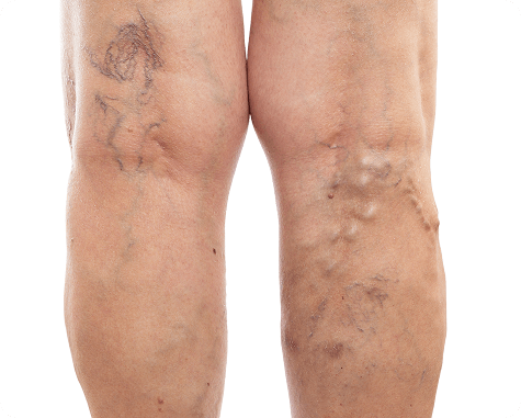 Vein massage