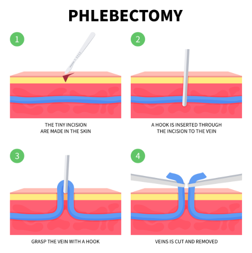 How microphlebectomy works