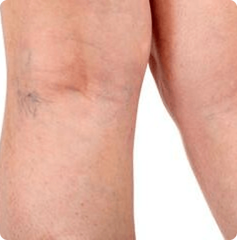 Sclerotherapy Treatment