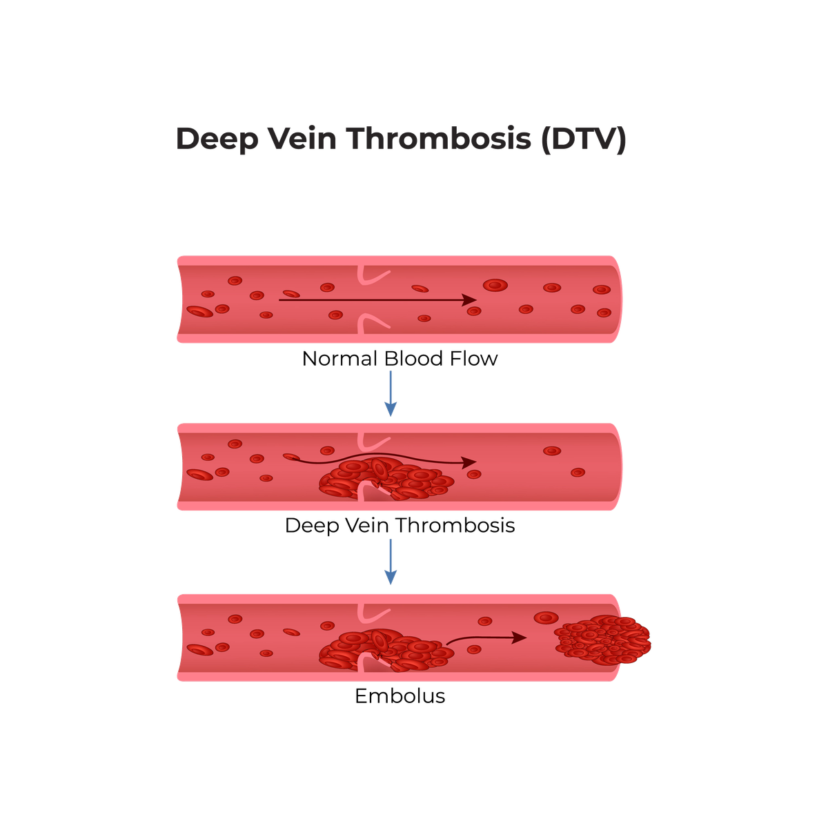 What causes DVT Graphic