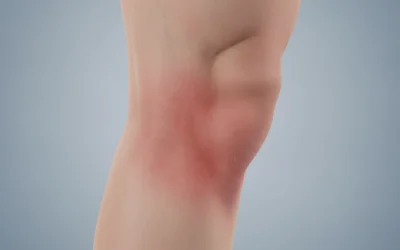 When to Seek Medical Attention for DVT Symptoms